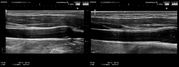 頚動脈超音波　実写1
