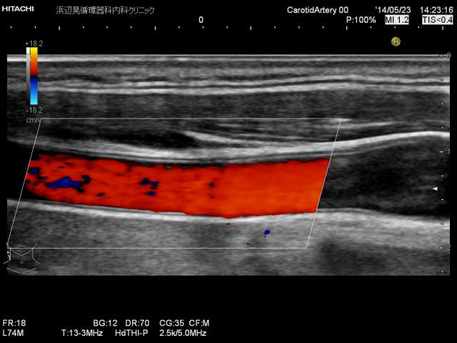 頚動脈超音波　実写2